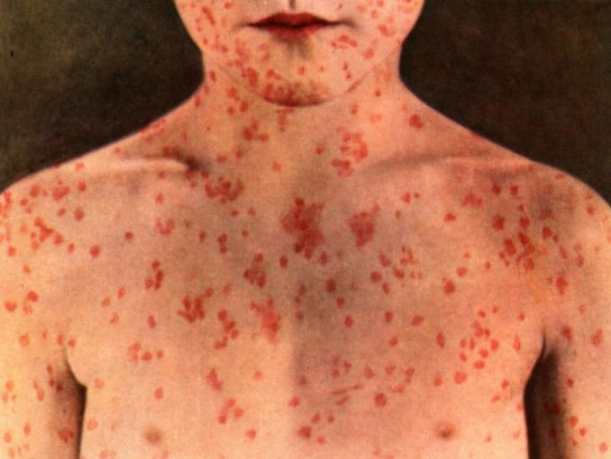 brote-sarampion-mexico-epidemia